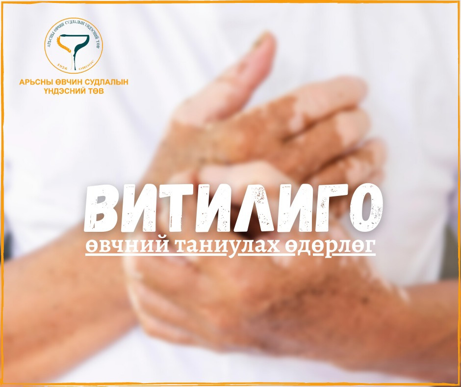 АӨСҮТөвийн Витилиго өвчний таниулах өдөрлөг